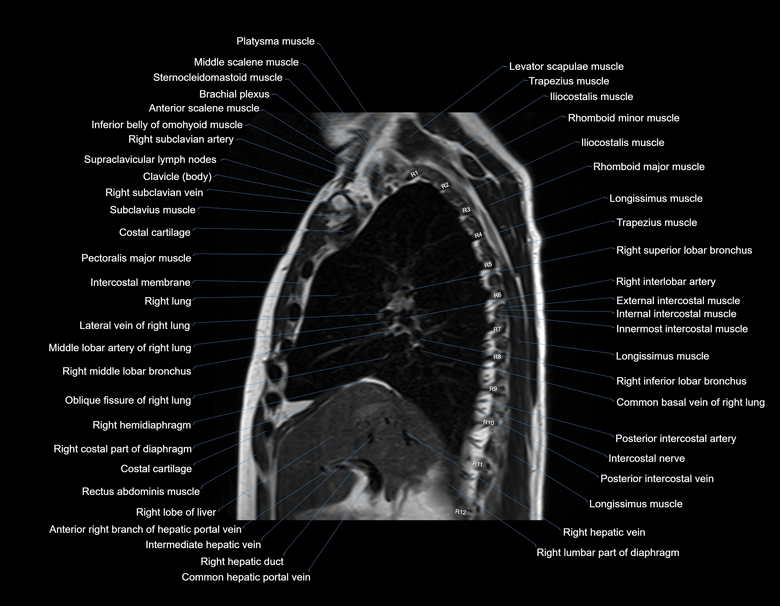 MRI chest (thorax) sagittal labelled cross sectional anatomy 3T radiology image-img-00001-00015.webp